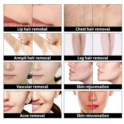 PuraSkin Pro IPL Laser System for Hair Removal