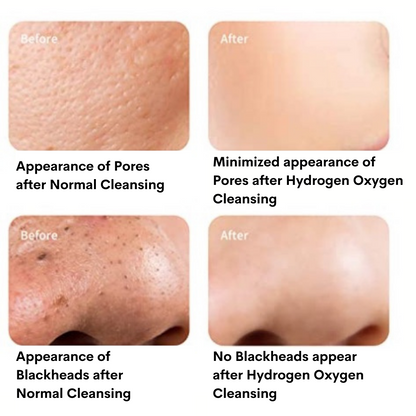 7 in 1 Professional Hydro Dermabrasion Machine
