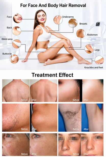 Professional Diode Laser Hair Removal Machine – LumiLASE