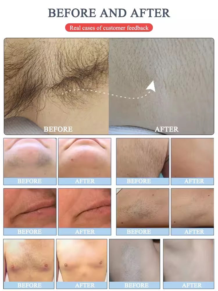 Multi Laser Platform - Hair Removal Diode + Nd YAG