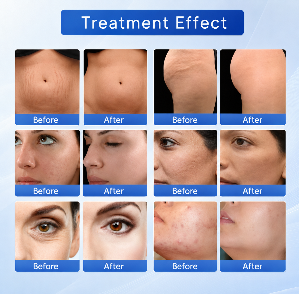 Metaphor 8 Microneedling RF Machine 3 In 1