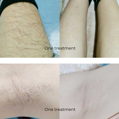 Diode ELITE4 Laser Hair Removal System